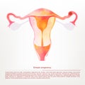 Vector illustration of female genitals, ectopic pregnancy. Royalty Free Stock Photo