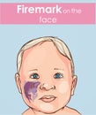 Vector illustration of a Firemark on the baby face. Royalty Free Stock Photo
