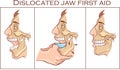 Vector illustration of a first aid dislocated Jaw