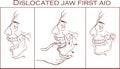 Vector illustration of a first aid dislocated Jaw