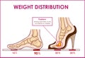 Vector illustration of foot pain and weight distribution by wearing high heels