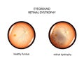 Eyeground. retinal dystrophy Royalty Free Stock Photo