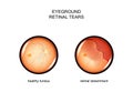 Fundus. retinal tears Royalty Free Stock Photo