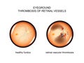Fundus. retinal vascular thrombosis Royalty Free Stock Photo