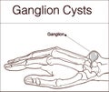 Vector illustration of a Ganglion cyst