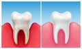 Vector illustration of gum disease - periodontitis in compare with healthy white tooth