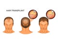 Hair transplantation of the occipital part of the head