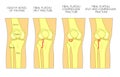 Bone fracture_Tibial plateau fracture