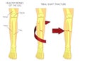 Bone fracture_Tibial shaft fracture