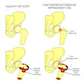 Hip joint problem_Cam femoroacetabular impingement with section