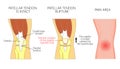 Anatomy_Patellar tendon rupture