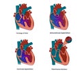 Vector illustration of the heart defects linked to the Down syndrome: septal defects, tetralogy of Fallot and patent ductur