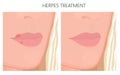 Plastic surgery_Herpes treatment