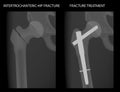 Pelvis and Hip joint problem_Intertrochanteric hip fracture treatment 1