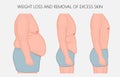 Human body problem_Weight loss and removal of excess skin side v Royalty Free Stock Photo