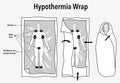 Vector illustration of a hypothermia wrap and first aid Royalty Free Stock Photo