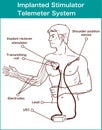 Vector illustration of a Implanted stimulator telemeter system