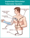 vector illustration of a Implanted stimulator telemeter system