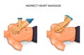 Indirect heart massage options Royalty Free Stock Photo