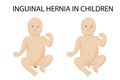 vector illustration of inguinal hernia in children.