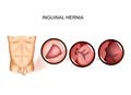 Inguinal hernia entrapment