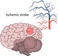 Vector illustration of ischemic stroke. Brain infarction. Royalty Free Stock Photo