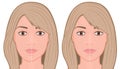 Face front_Jaw asymmetry correctiom surgery Face