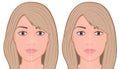 Face front_Jaw asymmetry correctiom surgery Face Royalty Free Stock Photo