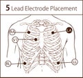 Vector illustration of a 5 lead electrode placement