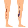 Vector illustration leg veins