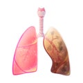 Vector illustration of lung cancer Royalty Free Stock Photo