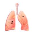 Vector illustration of lung cancer Royalty Free Stock Photo