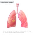 Vector illustration of lung cancer