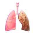 Vector illustration of lung cancer Royalty Free Stock Photo