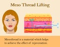 Vector illustration of meso threads lifting isolated Royalty Free Stock Photo