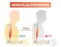 Vector illustration about muscular dystrophy. Compared normal muscle and atrophied muscle. Scheme with healthy and weak human.