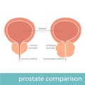 Vector illustration of normal and enlarged prostate