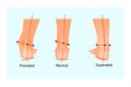 Vector illustration of the normal human foot and the foot with pronation and supination.