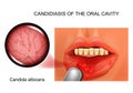 Candidiasis of the oral cavity Royalty Free Stock Photo