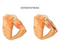 Osteosynthesis of the body of the humerus Royalty Free Stock Photo