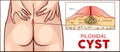 Vector illustration Pilonidal cyst formation