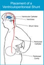 Placement of a ventriculoperitoneal shunt Royalty Free Stock Photo