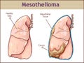 vector illustration of a Pleural mesothelioma Royalty Free Stock Photo