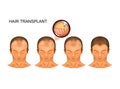 Process hair transplantation of the occipital part of the head