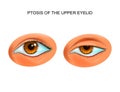 Ptosis of the eyelid Royalty Free Stock Photo