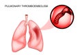 Pulmonary thromboembolism. thrombosis