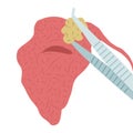 Vector illustration of removing a stone from the parotid salivary gland