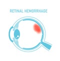 Vector illustration of retinal hemorrhage Royalty Free Stock Photo