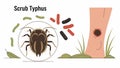 Vector Illustration of Scrub Typhus Royalty Free Stock Photo