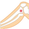 Vector illustration of the sick knee of the person